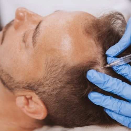 Mesotherapy Hair Treatment For Hair Loss | Elements Medical